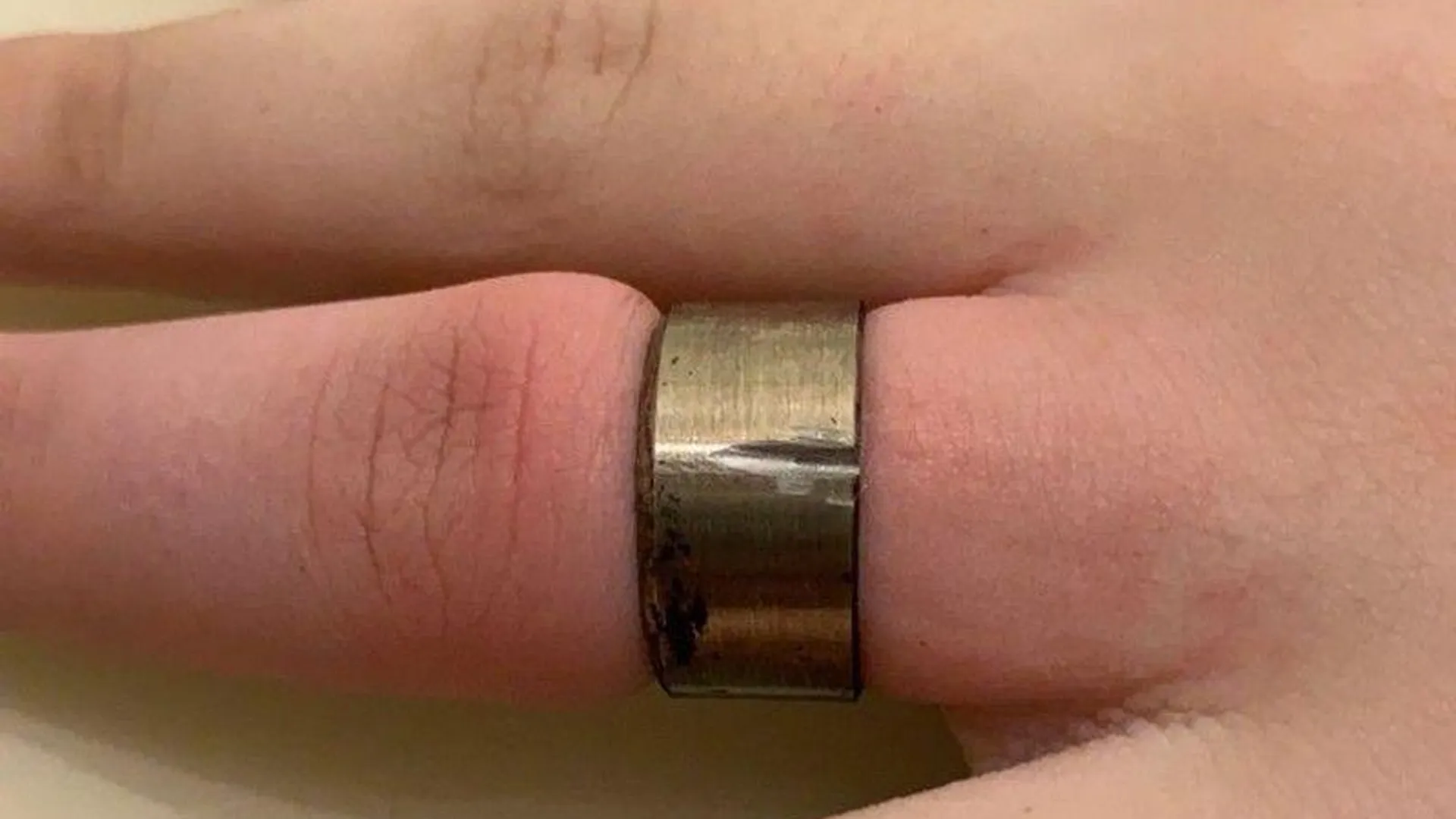 В Краснознаменске спасатели сняли с пальца ребенка кольцо от шампура