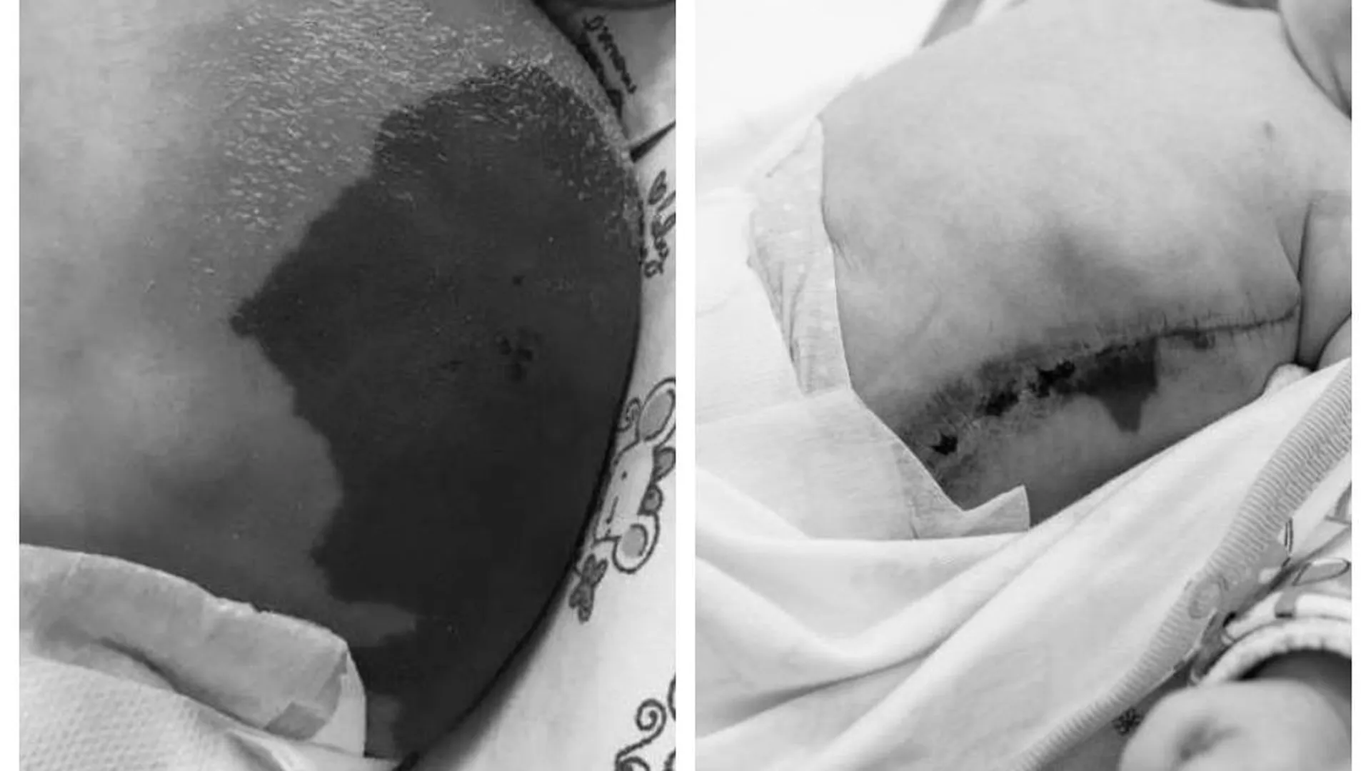 Новорожденного с огромной лимфангиомой передней брюшной стенки прооперировали в Щелкове